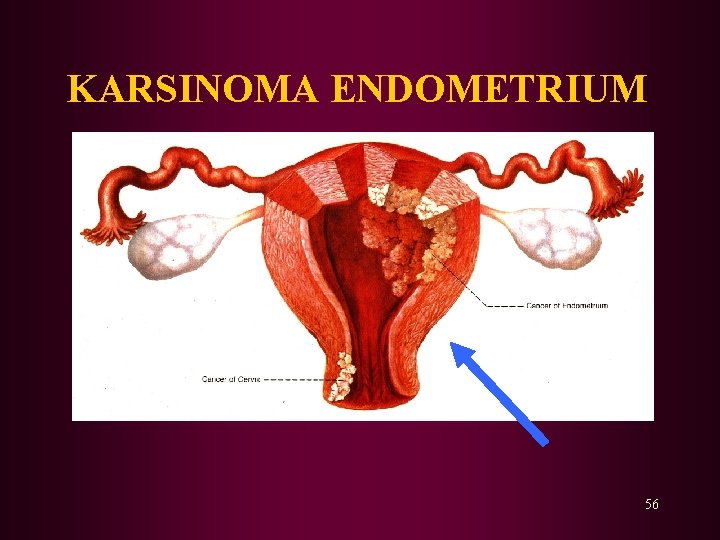KARSINOMA ENDOMETRIUM 56 KARSINOMA ENDOMETRIUM 56