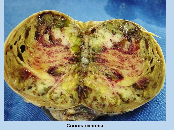 Coriocarcinoma 