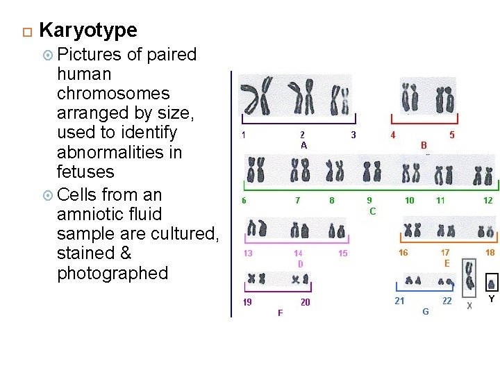  Karyotype Pictures of paired human chromosomes arranged by size, used to identify abnormalities