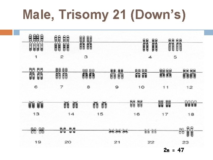 Male, Trisomy 21 (Down’s) 2 n = 47 30 