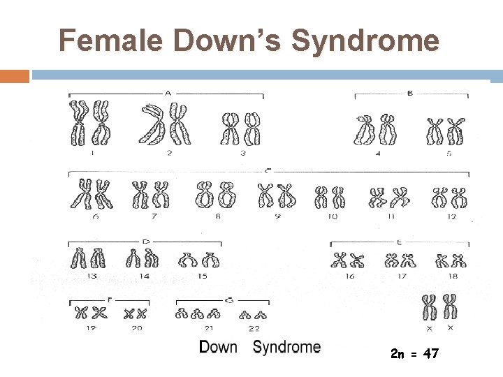 Female Down’s Syndrome 2 n = 47 31 