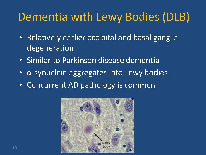 Dementia with Lewy Bodies (DLB) • Relatively earlier occipital and basal ganglia degeneration •