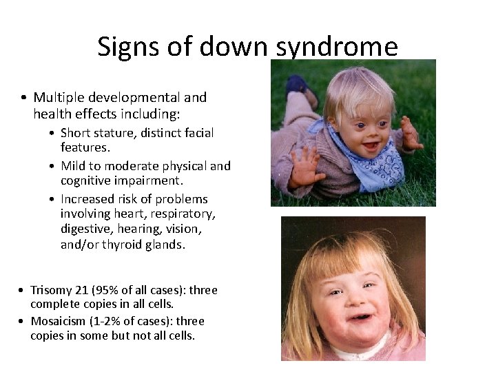 Signs of down syndrome • Multiple developmental and health effects including: • Short stature,