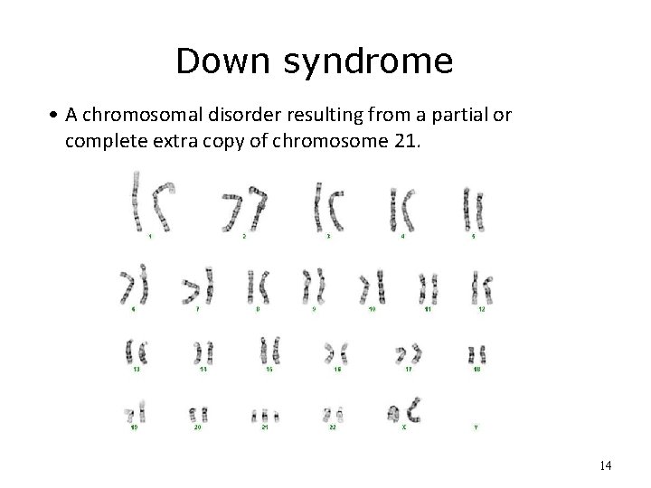 Down syndrome • A chromosomal disorder resulting from a partial or complete extra copy