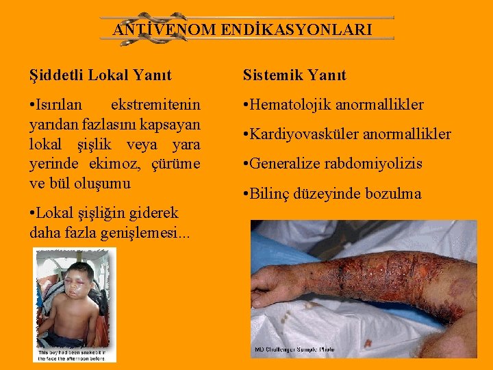 ANTİVENOM ENDİKASYONLARI Şiddetli Lokal Yanıt Sistemik Yanıt • Isırılan ekstremitenin yarıdan fazlasını kapsayan lokal