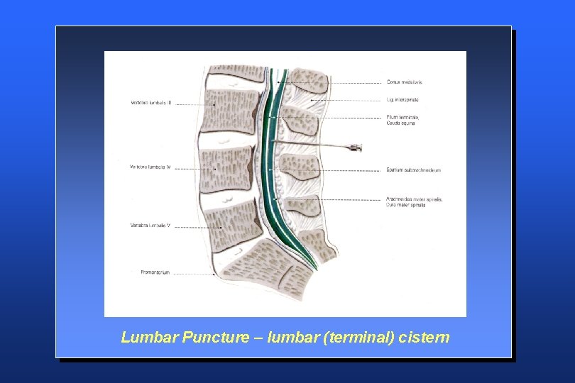 Lumbar Puncture – lumbar (terminal) cistern 