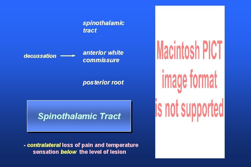 spinothalamic tract decussation anterior white commissure posterior root Spinothalamic Tract - contralateral loss of