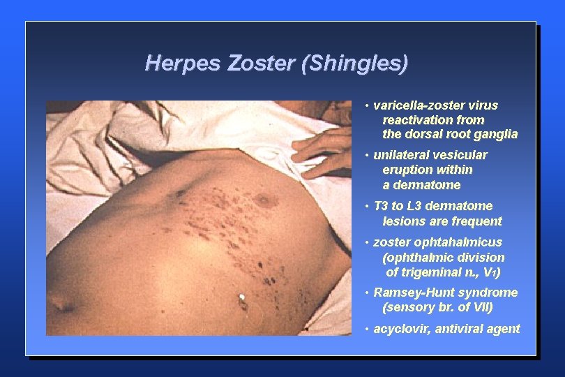 Herpes Zoster (Shingles) • varicella-zoster virus reactivation from the dorsal root ganglia • unilateral