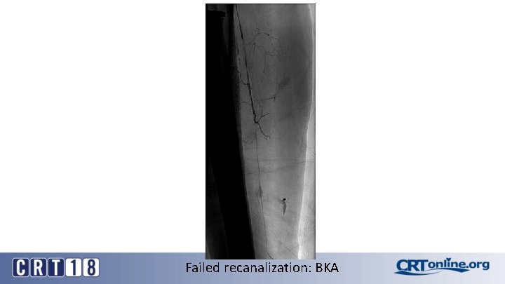 Failed recanalization: BKA 