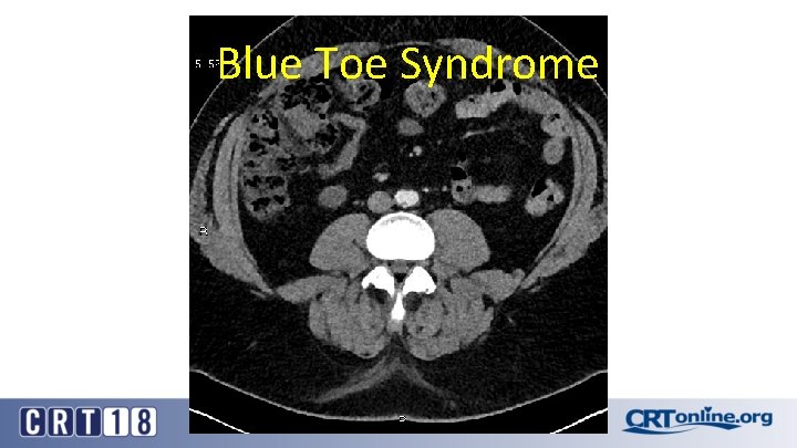 Blue Toe Syndrome 