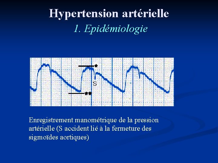 Hypertension artérielle 1. Epidémiologie Enregistrement manométrique de la pression artérielle (S accident lié à