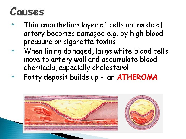 Causes Thin endothelium layer of cells on inside of artery becomes damaged e. g.