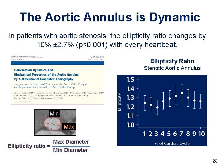 The Aortic Annulus is Dynamic In patients with aortic stenosis, the ellipticity ratio changes The Aortic Annulus is Dynamic In patients with aortic stenosis, the ellipticity ratio changes