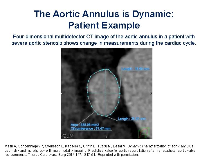 The Aortic Annulus is Dynamic: Patient Example Four-dimensional multidetector CT image of the aortic The Aortic Annulus is Dynamic: Patient Example Four-dimensional multidetector CT image of the aortic