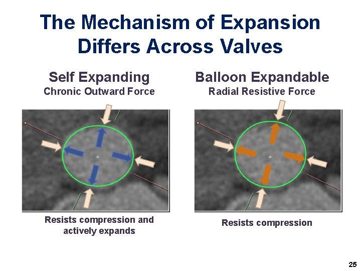 The Mechanism of Expansion Differs Across Valves Self Expanding Balloon Expandable Chronic Outward Force The Mechanism of Expansion Differs Across Valves Self Expanding Balloon Expandable Chronic Outward Force