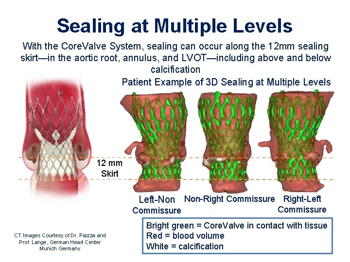 Sealing at Multiple Levels With the Core. Valve System, sealing can occur along the Sealing at Multiple Levels With the Core. Valve System, sealing can occur along the