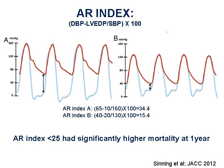 AR INDEX: (DBP-LVEDP/SBP) X 100 AR index A: (65 -10/160)X 100=34. 4 AR index AR INDEX: (DBP-LVEDP/SBP) X 100 AR index A: (65 -10/160)X 100=34. 4 AR index