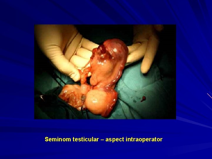 Seminom testicular – aspect intraoperator 