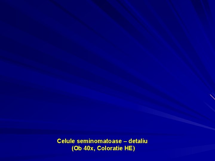 Celule seminomatoase – detaliu (Ob 40 x, Coloratie HE) 