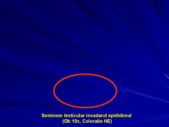 Seminom testicular invadand epididimul (Ob 10 x, Coloratie HE) 
