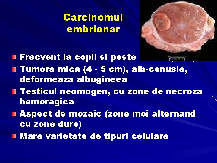 Carcinomul embrionar Frecvent la copii si peste 40 ani (25%) Tumora mica (4 -