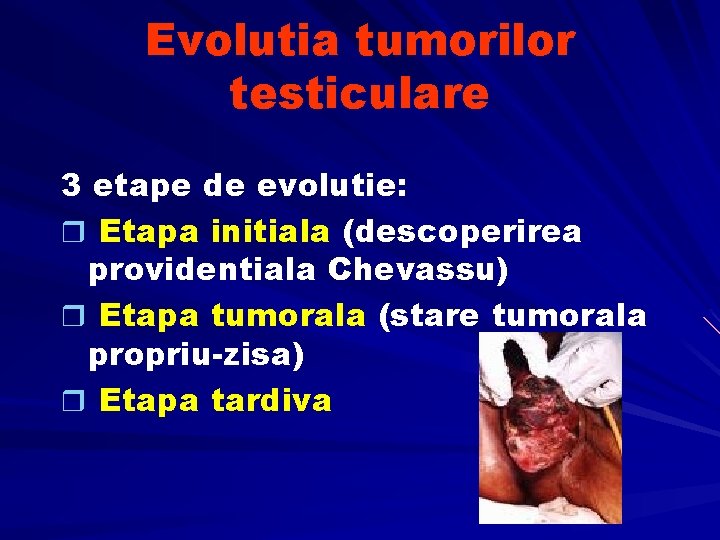 Evolutia tumorilor testiculare 3 etape de evolutie: r Etapa initiala (descoperirea providentiala Chevassu) r