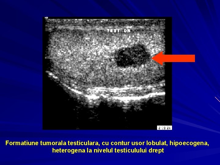 Formatiune tumorala testiculara, cu contur usor lobulat, hipoecogena, heterogena la nivelul testiculului drept 