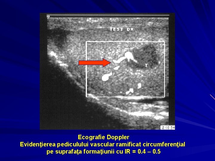 Ecografie Doppler Evidenţierea pediculului vascular ramificat circumferenţial pe suprafaţa formaţiunii cu IR = 0.