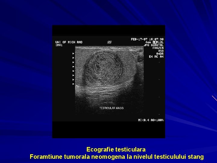 Ecografie testiculara Foramtiune tumorala neomogena la nivelul testiculului stang 