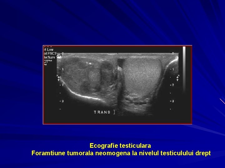 Ecografie testiculara Foramtiune tumorala neomogena la nivelul testiculului drept 