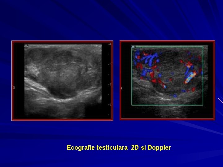 Ecografie testiculara 2 D si Doppler 