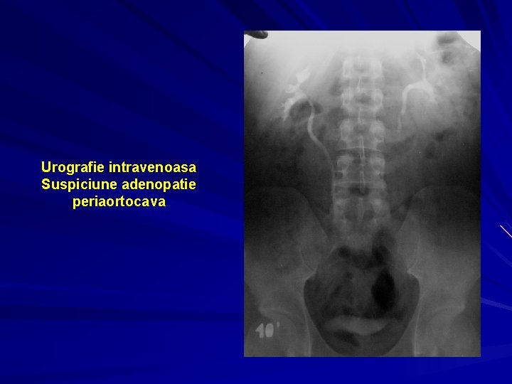 Urografie intravenoasa Suspiciune adenopatie periaortocava 