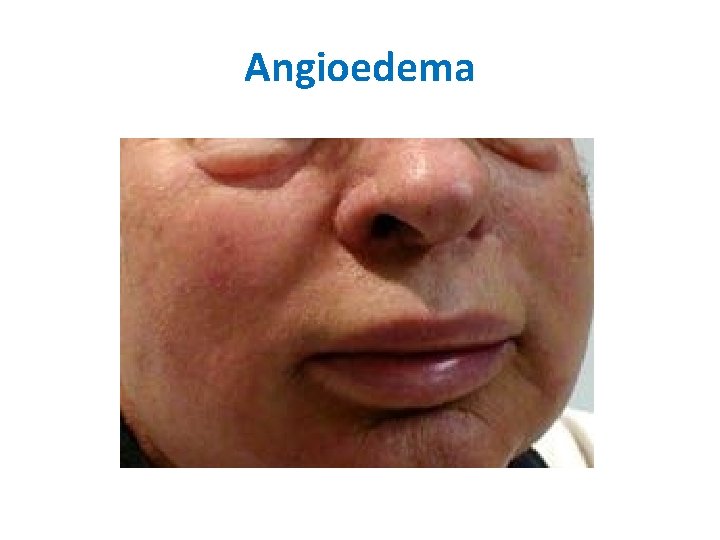 Angioedema Angioedema