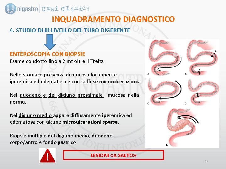 INQUADRAMENTO DIAGNOSTICO 4. STUDIO DI III LIVELLO DEL TUBO DIGERENTEROSCOPIA CON BIOPSIE Esame condotto INQUADRAMENTO DIAGNOSTICO 4. STUDIO DI III LIVELLO DEL TUBO DIGERENTEROSCOPIA CON BIOPSIE Esame condotto