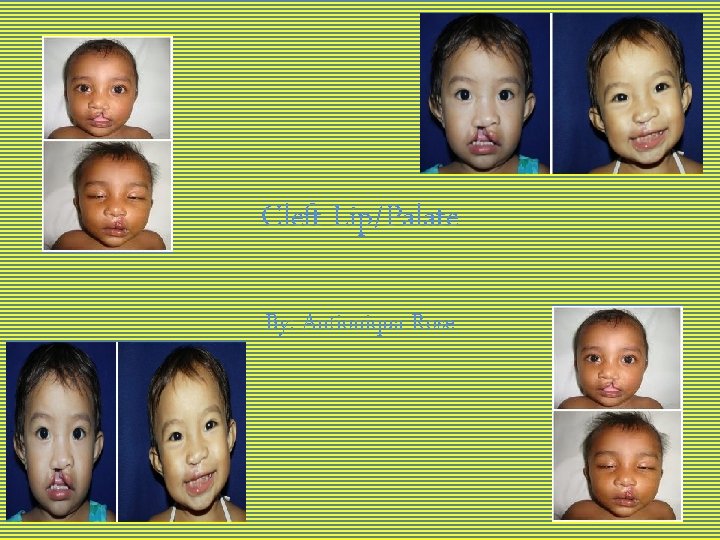 Cleft Lip/Palate By: Antioniqua Rose 