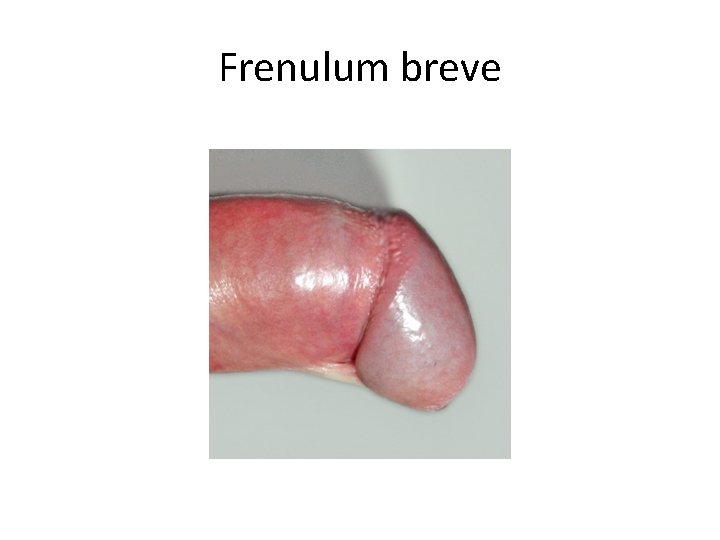 Frenulum breve 