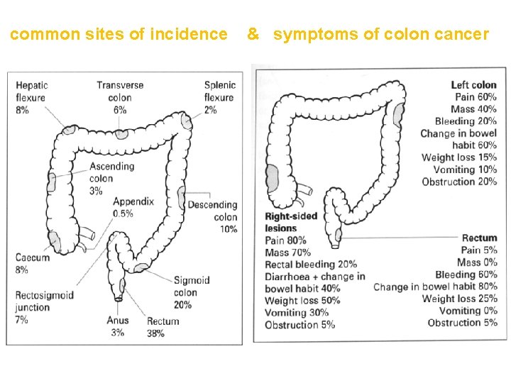 common sites of incidence & symptoms of colon cancer 