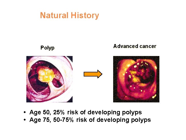 Natural History Polyp Advanced cancer • Age 50, 25% risk of developing polyps •