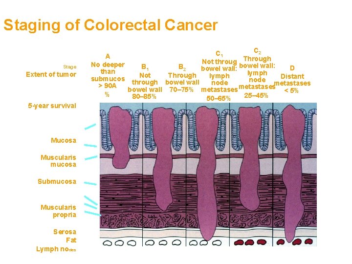 Staging of Colorectal Cancer Stage Extent of tumor 5 -year survival Mucosa Muscularis mucosa