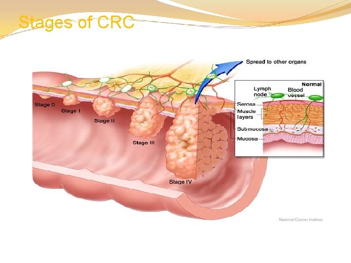 Stages of CRC 