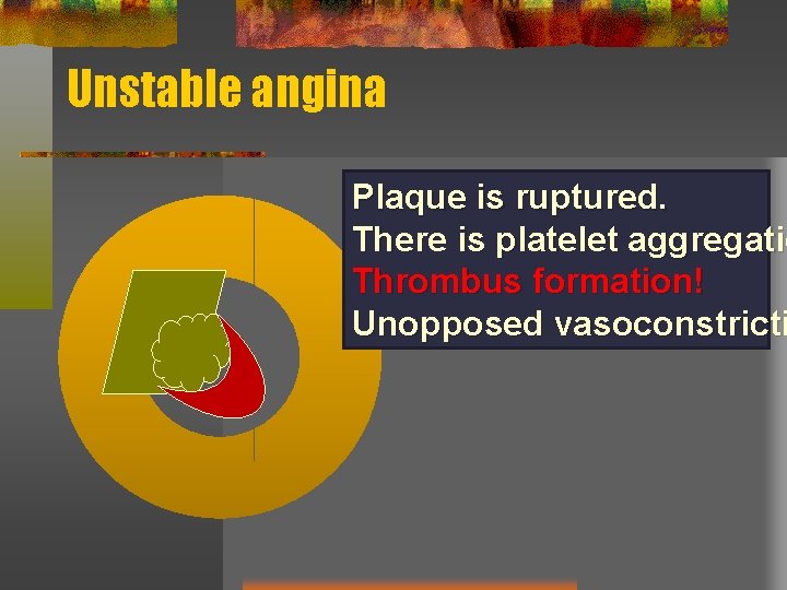 Unstable angina Plaque is ruptured. There is platelet aggregatio Thrombus formation! Unopposed vasoconstricti 