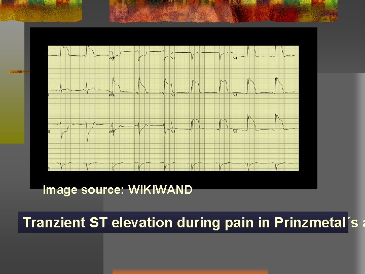 Image source: WIKIWAND Tranzient ST elevation during pain in Prinzmetal´s a 