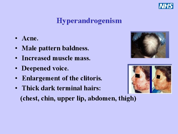 Hyperandrogenism • • • Acne. Male pattern baldness. Increased muscle mass. Deepened voice. Enlargement
