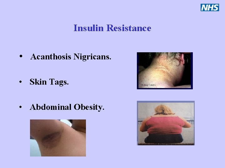 Insulin Resistance • Acanthosis Nigricans. • Skin Tags. • Abdominal Obesity. 