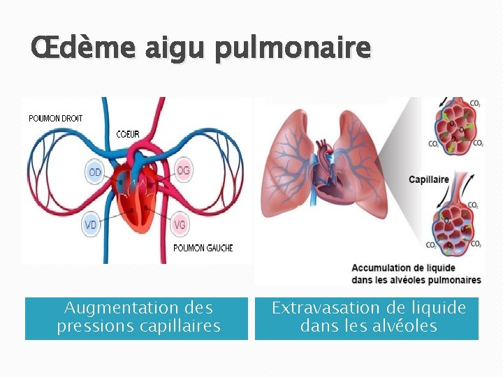 Œdème aigu pulmonaire Augmentation des pressions capillaires Extravasation de liquide dans les alvéoles 