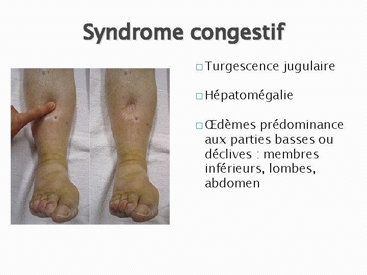 Syndrome congestif � Turgescence jugulaire � Hépatomégalie � Œdèmes prédominance aux parties basses ou