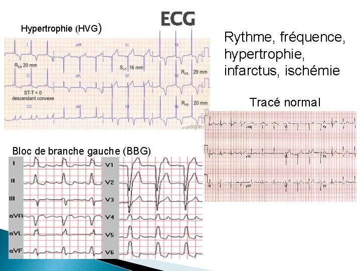 Hypertrophie (HVG) ECG Rythme, fréquence, hypertrophie, infarctus, ischémie Tracé normal Bloc de branche gauche