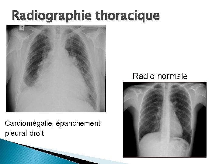 Radiographie thoracique Radio normale Cardiomégalie, épanchement pleural droit 