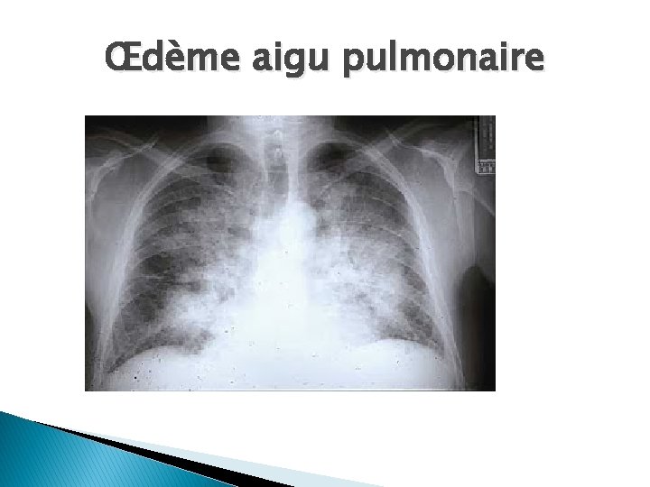 Œdème aigu pulmonaire 