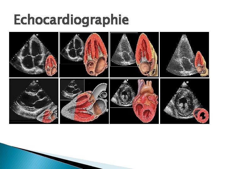 Echocardiographie 